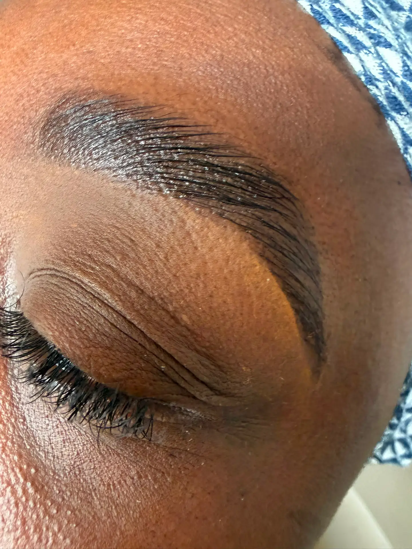 Browlift