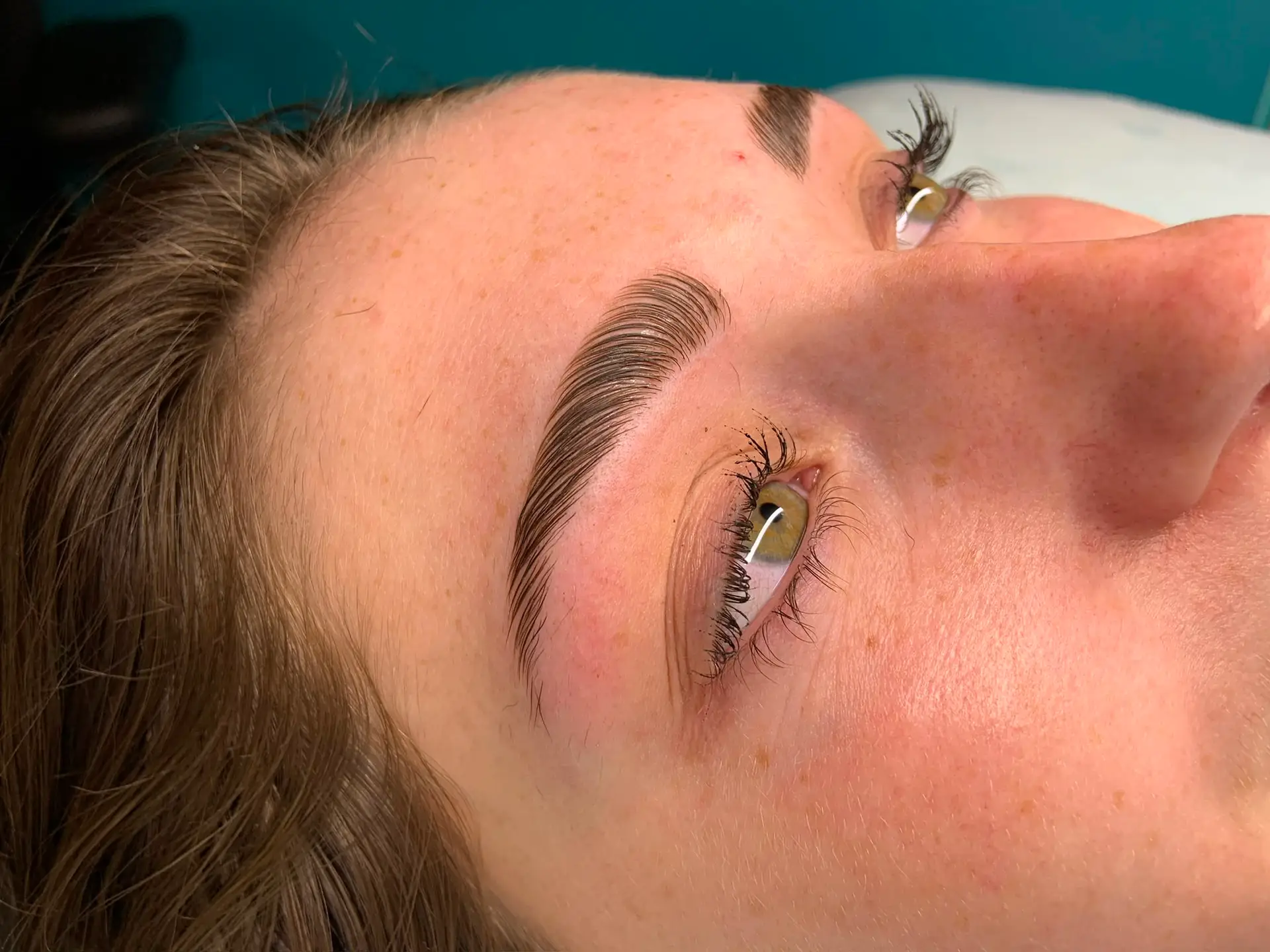 Browlift